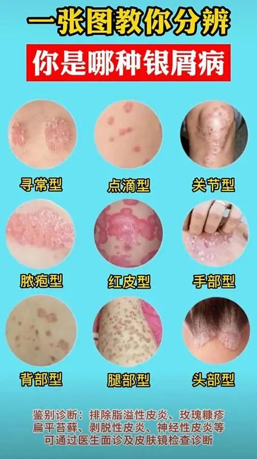 银屑病饮食：牛羊肉该吃吗？(图4)