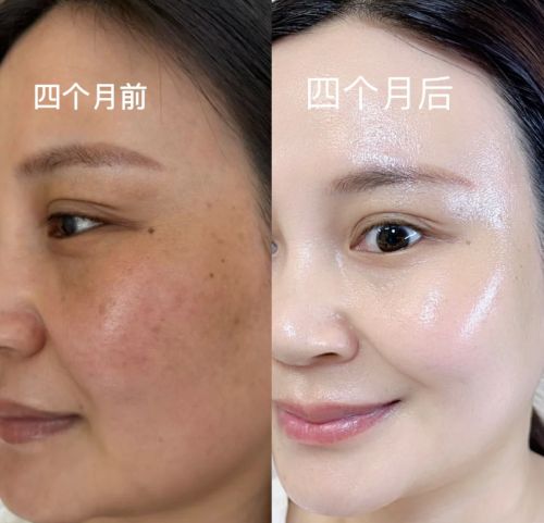 淡斑护肤品哪个品牌最好国家唯一认证的祛斑产品闭眼入不踩雷(图5)