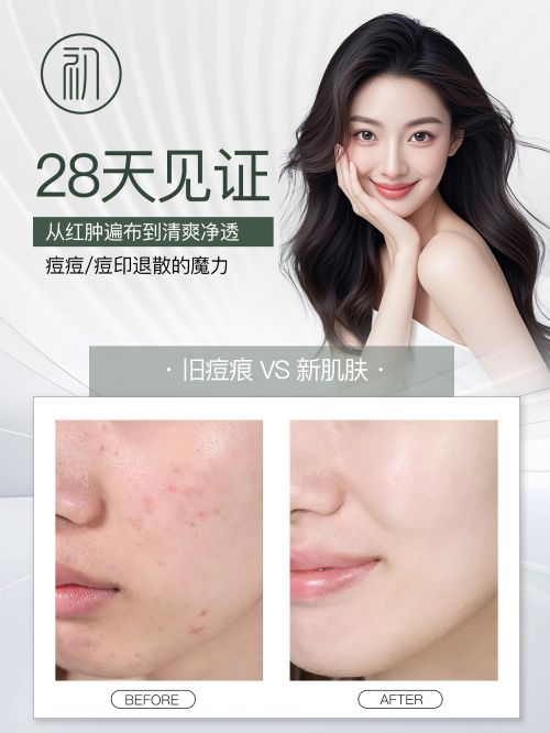 祛痘膏哪个牌子最好最有效？祛痘最有效的药膏这10灭痘快准狠(图4)