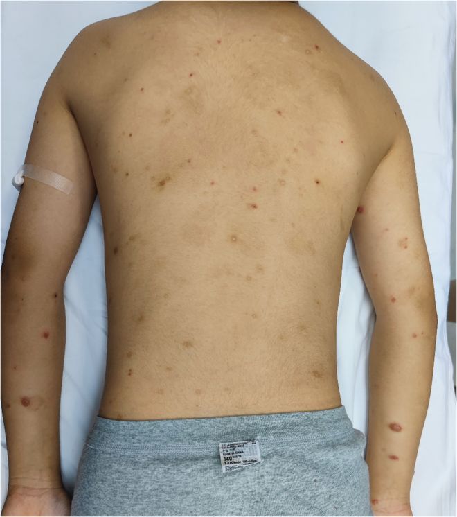 【“蒲公英杯”健康科普大赛】皮肤的“SOS”信号：结节性痒疹与过敏的故事(图1)