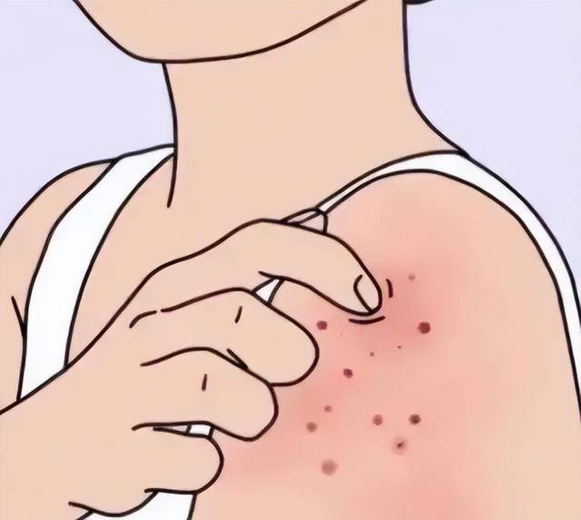 湿疹反复发作痒得睡不着觉？做好3点护理防止复发(图1)